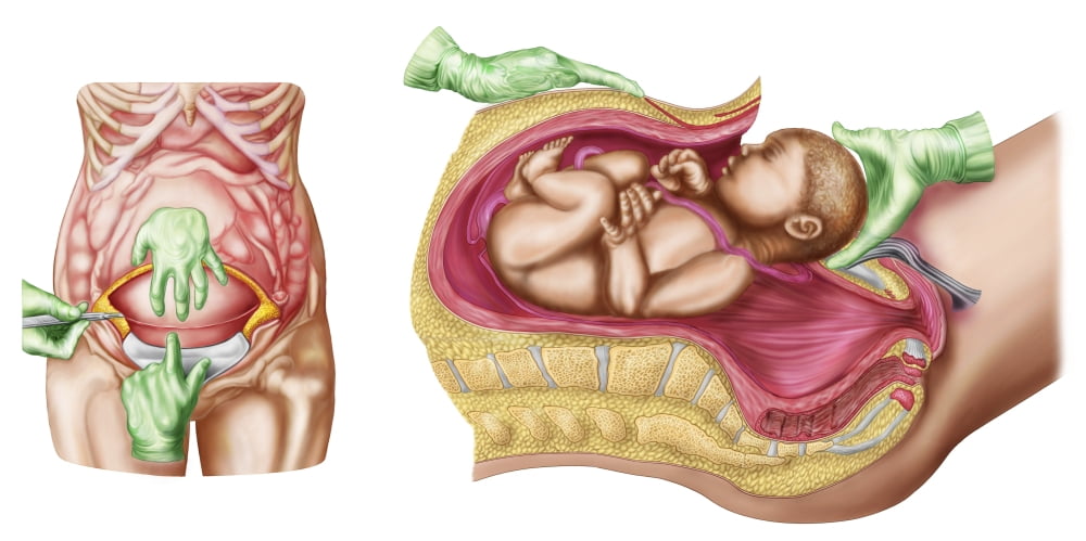 Illustration showing Caesarean delivery of fetus Canvas Art - Stocktrek Images (40 x 20)