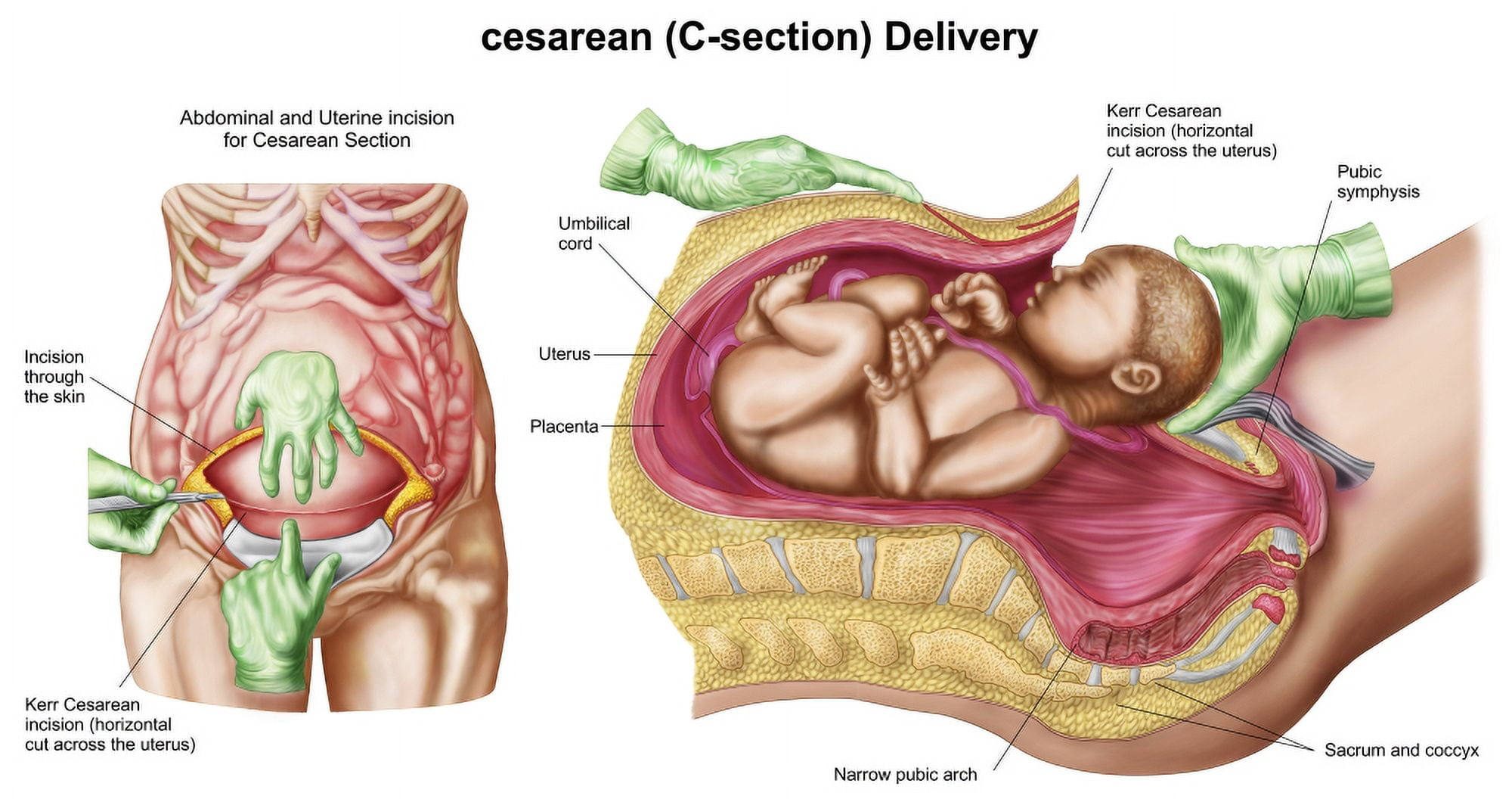Illustration showing Caesarean delivery of fetus Canvas Art - Stocktrek Images (40 x 21)