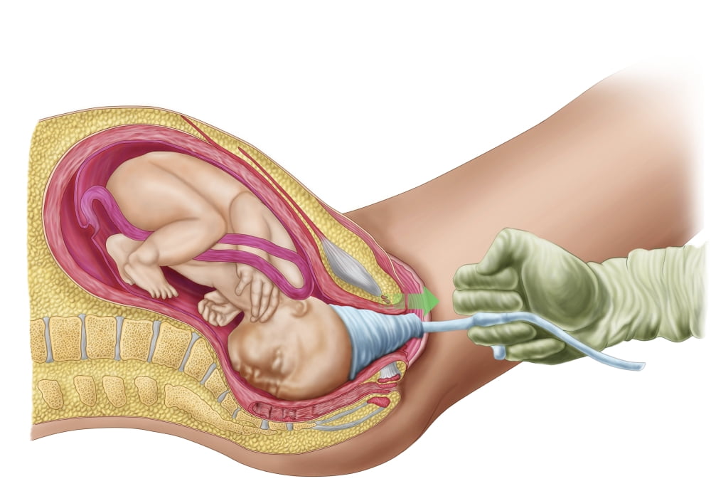 Illustration showing delivery of fetus using vacuum extraction Canvas Art - Stocktrek Images (34 x 24)