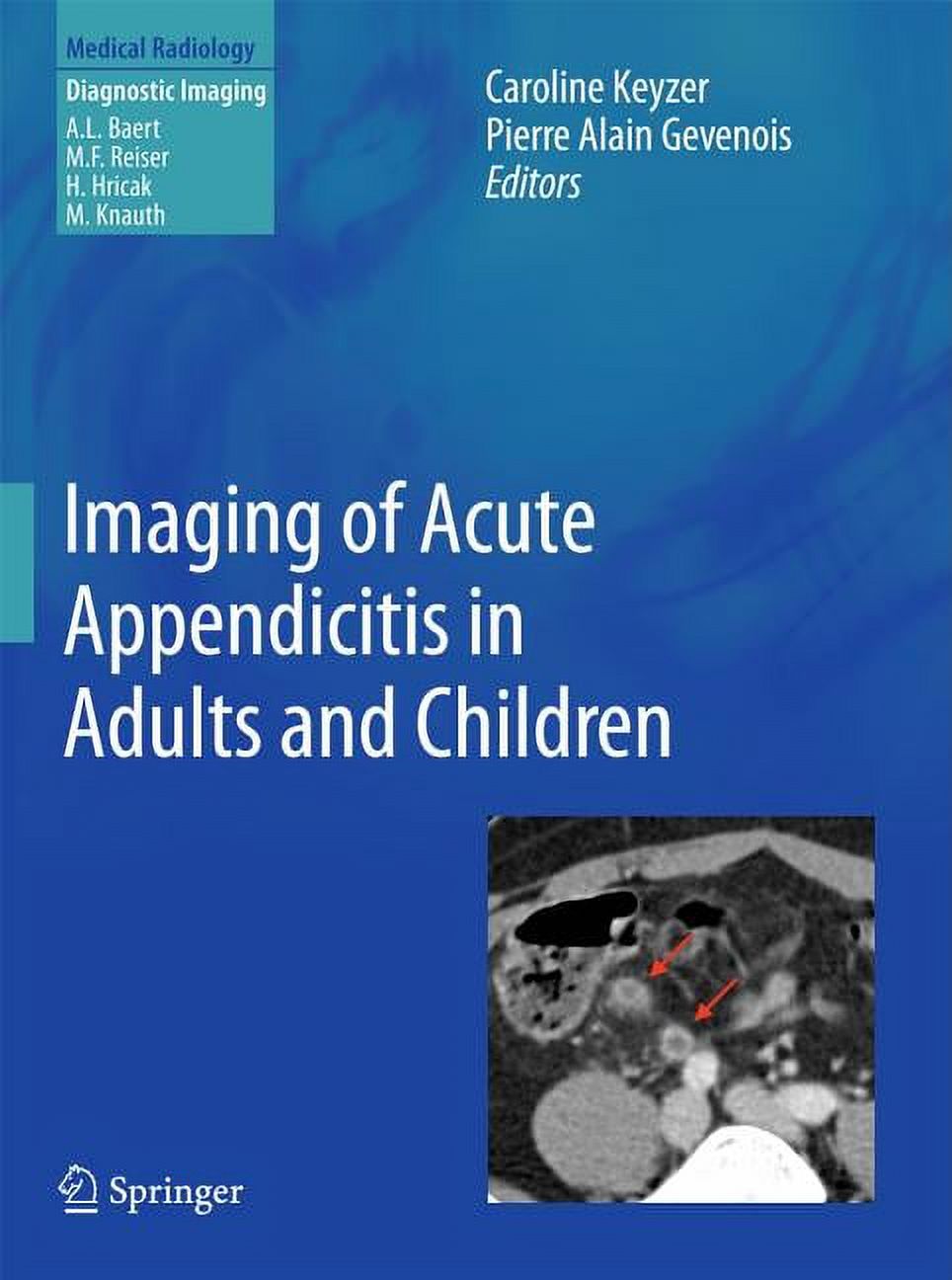 Imaging of Acute Appendicitis in Adults and Children (Hardcover ...