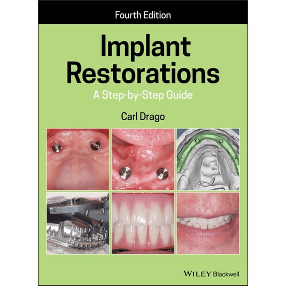 Implant Restorations: A Step-By-Step Guide (Hardcover)