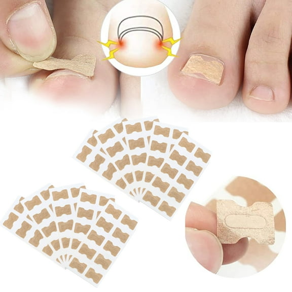 Ingrown Toenail Correction Stickers, Painless Pedicure Toenail Corrector Patch Toenail Treatment Tool Foot Carequantity:100 pieces;