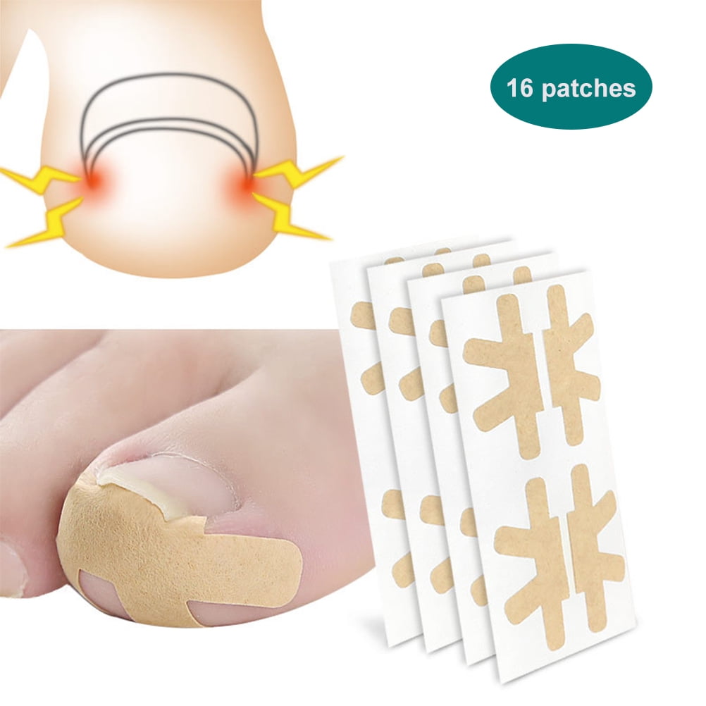 Sticker Corrector Ingrown Toenail Corrector Stickers Paronychia Recover Corrector ...
