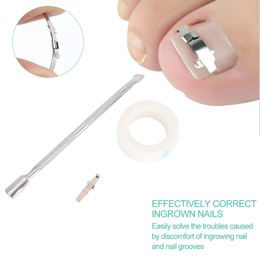 Ingrown Toenail Corrector§ingrowing Nail Corrector§paronychia Treatment