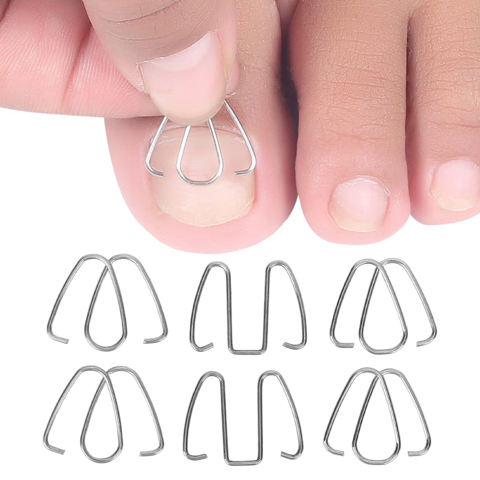 5Th Toe Nail Ingrown? The Vertical Implantation Solution You Need - sqe6rfs