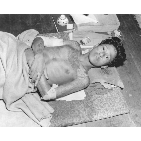 Japanese Male Victim Of The Atom Bomb Explosion Over Nagasaki History (24 x 18)