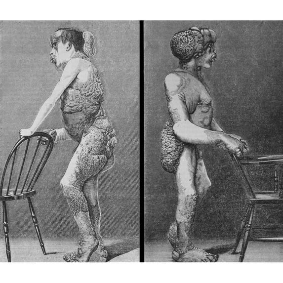 Joseph Merrick History Poster Print