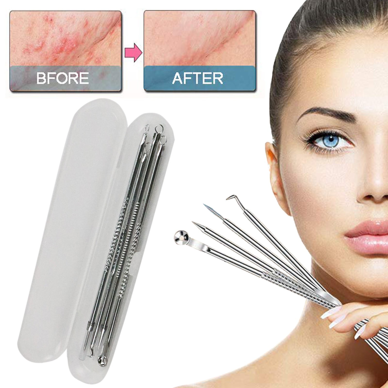 KEGUALV Pimple Tool Kit With Extractor Milia Removal Tool Blackhead Tweezers And Remover Tool