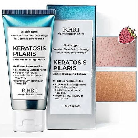 KP Bump Eraser Lotion Keratosis Pilaris Lotion with Glycolic Acid, AHA & BHA Exfoliating Rough & Bumpy Skin Body Lotion