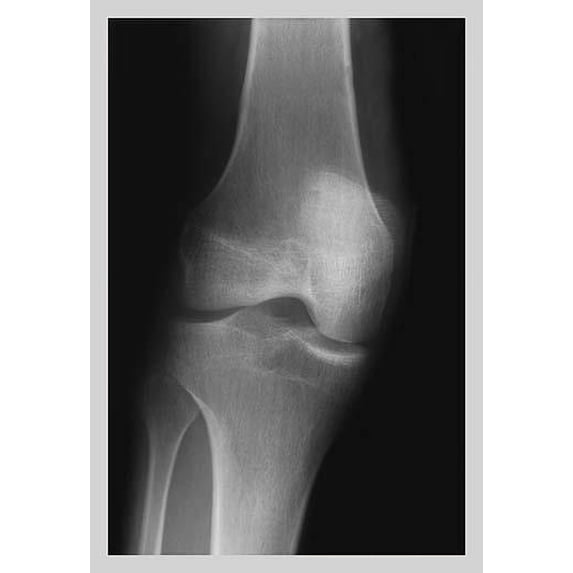 Knee-Fine Art Canvas Print (20" x 30")