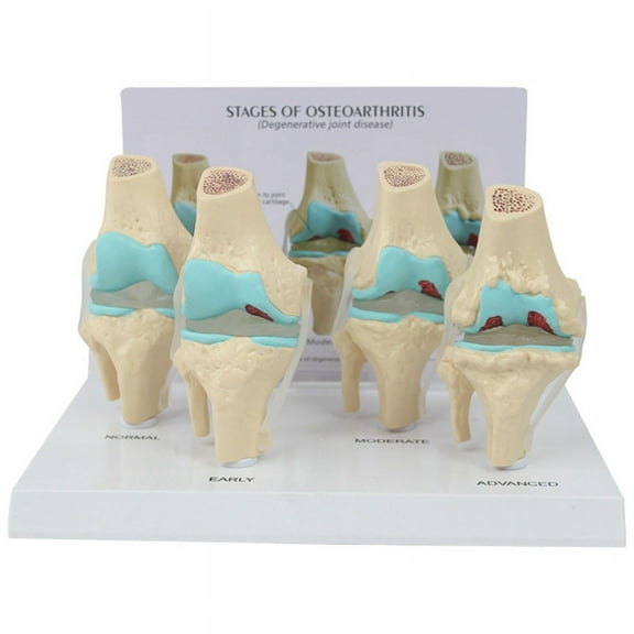 Knee Kit Osteoarthritis Anatomy Model with Educational Key Card 4 Stage Knee Model Orthopedic Teaching Aids