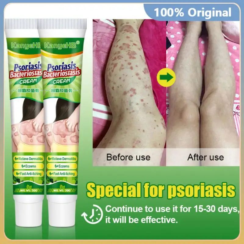 Kor 110pcs 2022 New Psoriasis Cream Eczema Ointment Scalp Psoriasis