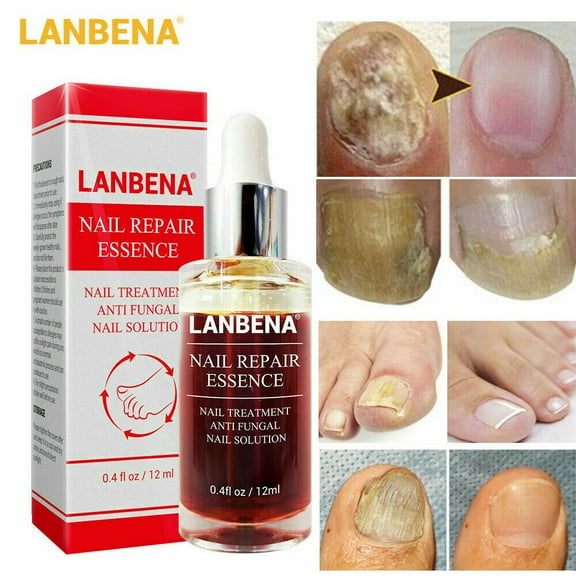 LANBENA Nail Repair Essence Serum Remove Onychomycosis Fungal Nail Treatment USA