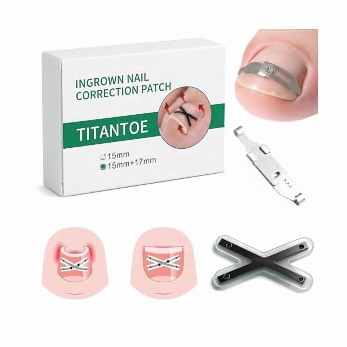 LYH Ingrown Toenail Treatment Kit, Titanium Alloy Ingrown Toenail Corrector Strips for Big Toe, Toenail Curve Corrector & Straightener for Curled Nails, At-Home Ingrown Nail Pain Relief, 6Pcs