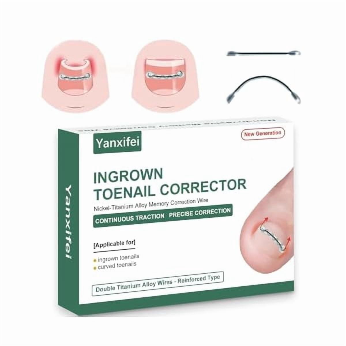 LYHDual Nitinol Ingrown Toenail Corrector,Ingrown Toenail Treatment,Curved Toenail Straightener,Ingrown Toenail Removal Kit,Big Toe Ingrown Toenail Tool (0.55in,0.66in)
