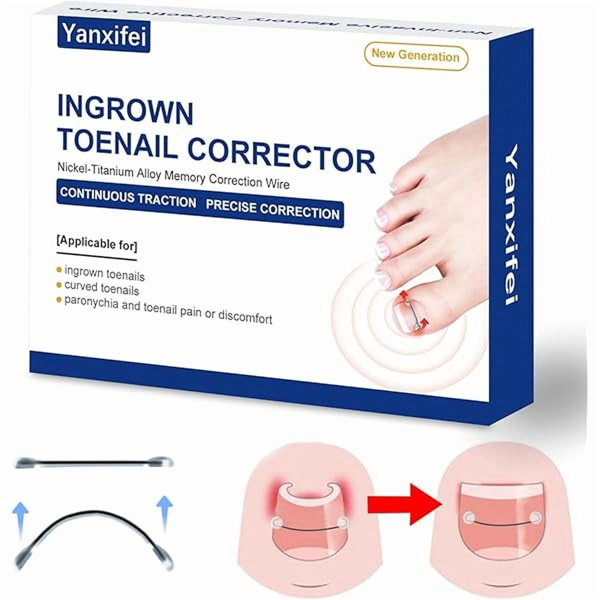 LYHNitinol Ingrown Toenail Corrector,at Home Ingrown Toenail Treatment,Curved Toenail Straightener,Ingrown Toe Nail Relief，Ingrown Toenail Removal Kit (1/2 In,11/16 In)
