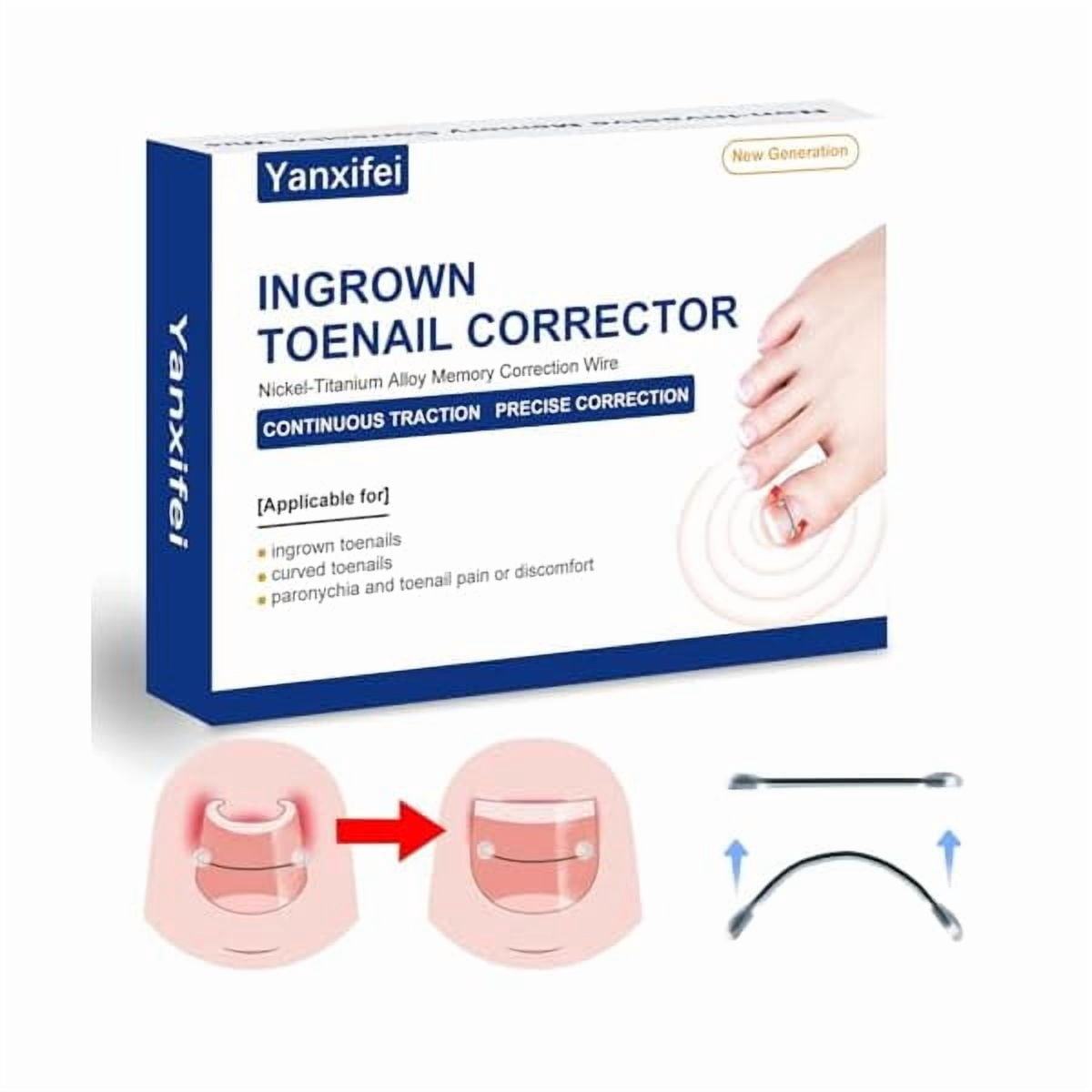 LYHNitinol Ingrown Toenail Corrector,at Home Ingrown Toenail Treatment,Curved Toenail Straightener,Ingrown Toe Nail Relief，Ingrown Toenail Removal Kit (11/16 In,13/16 In)