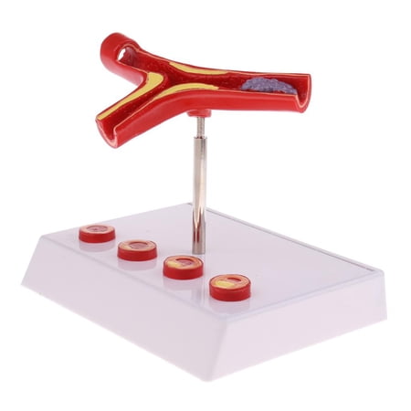 Lab/ Study - Human Vessel Thrombosis Atherosclerosis Vascular Model, Model, Science