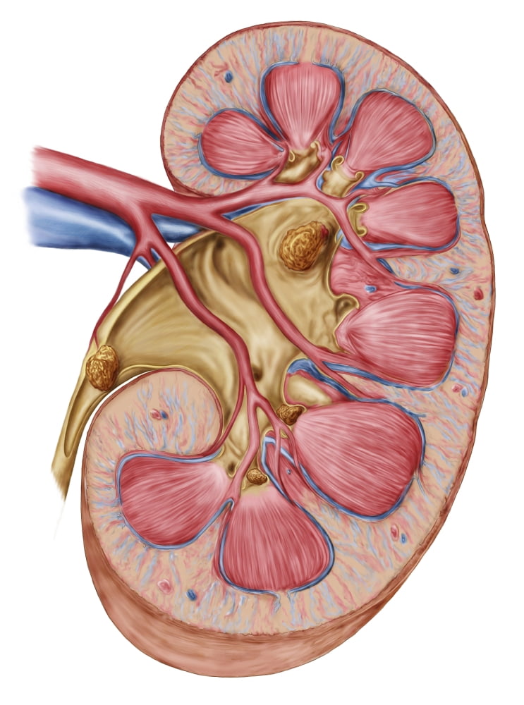 Large staghorn calculus in the human kidney Canvas Art - Stocktrek Images (12 x 17)