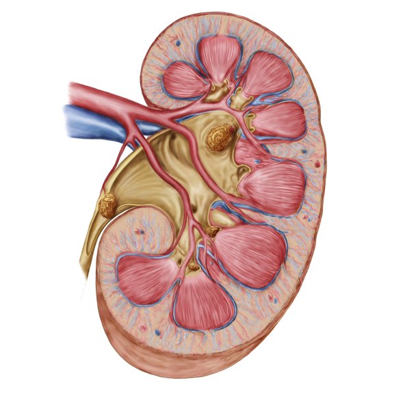 Large staghorn calculus in the human kidney Canvas Art - Stocktrek Images (24 x 33)