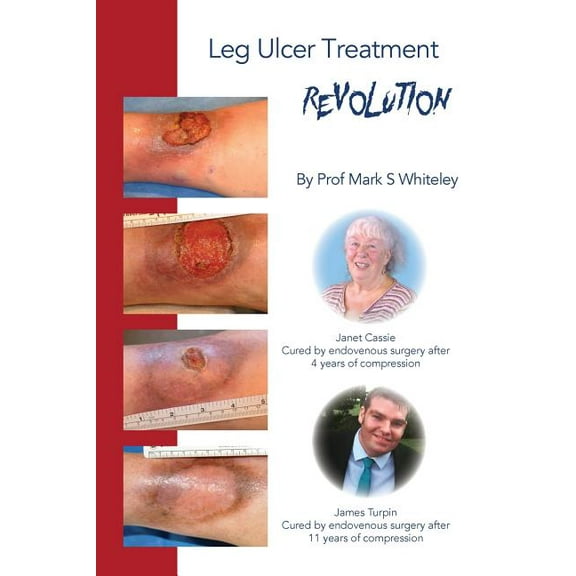 Leg Ulcer Treatment Revolution, (Paperback)