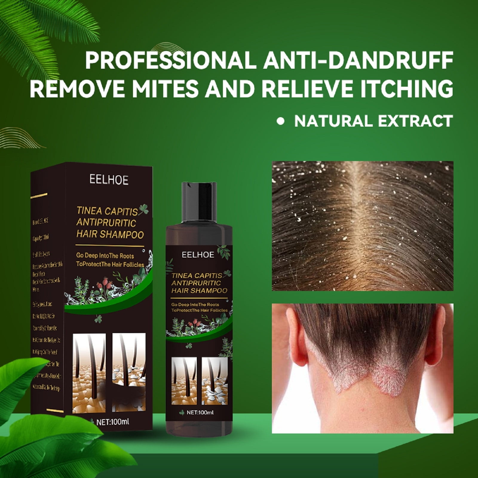 Lingouzi Anti-itch Shampoo For Tinea Capitis To Remove Dandruff And Relieve  Itchy Scalp 