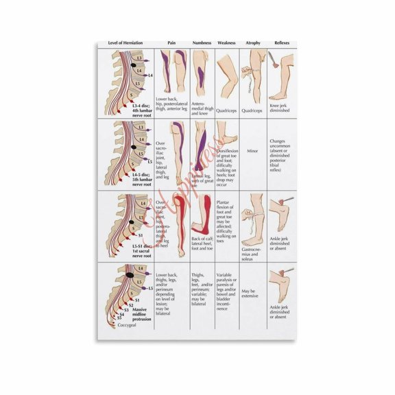 Lumbar Disc Herniation Level And Symptom Chart Nerve Root Mapping Poster Canvas Painting Wall Art