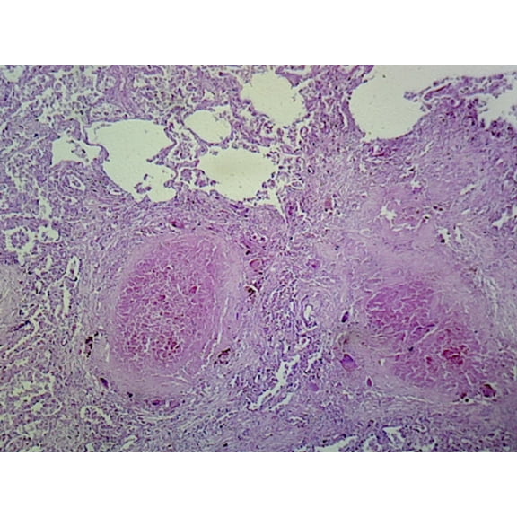Lung Tuberculosis (Human Respiratory System); Section; H&E Stain by Go Science Crazy