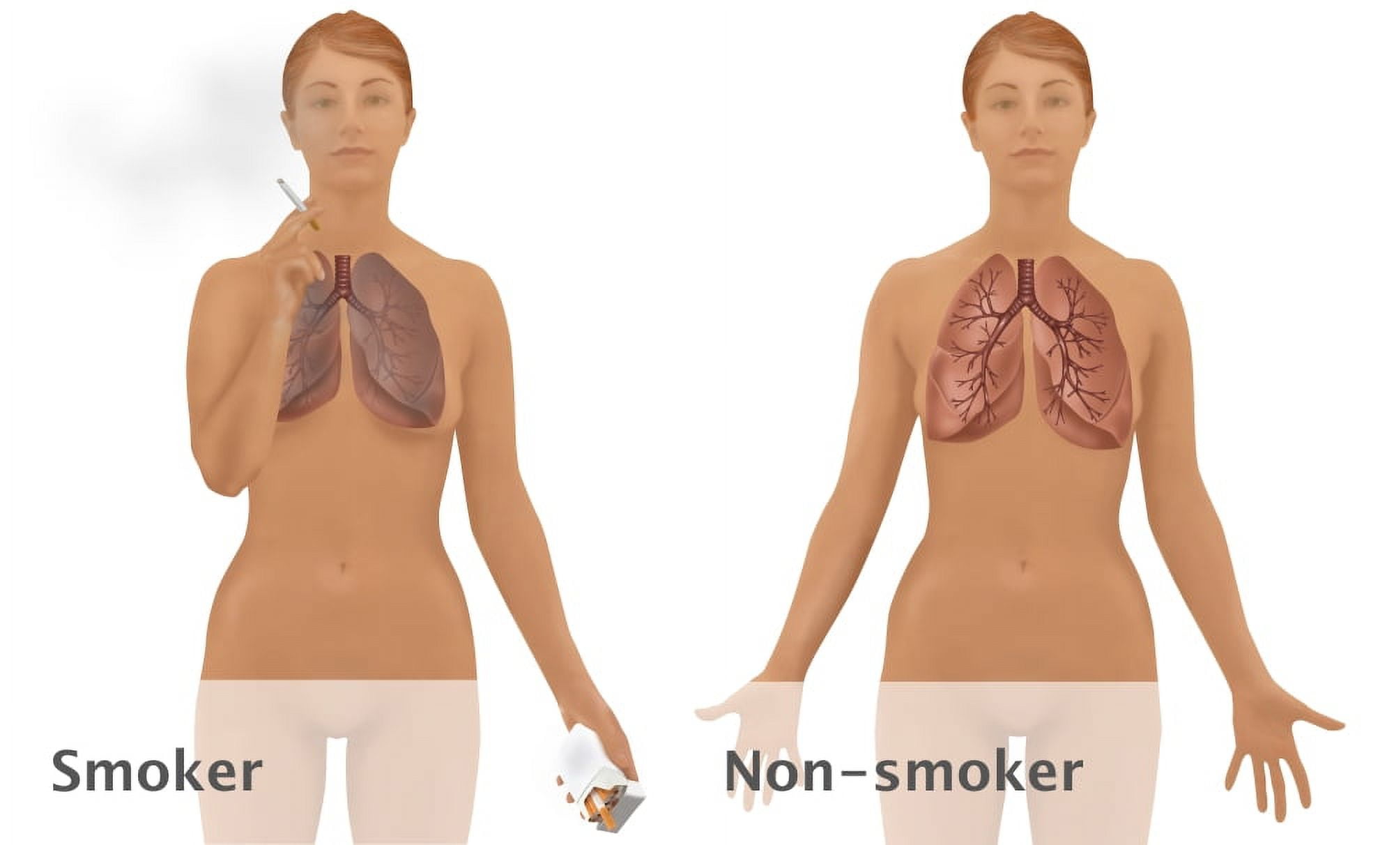 Lungs of Smoker vs. NonSmoker Poster Print by Gwen Shockey/Science