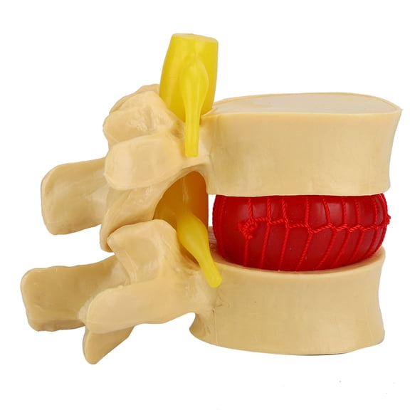 M Buder 1:1.5 Lumbar Disc Herniation Demonstration Model Study Learn Human Spine Anatomy Model