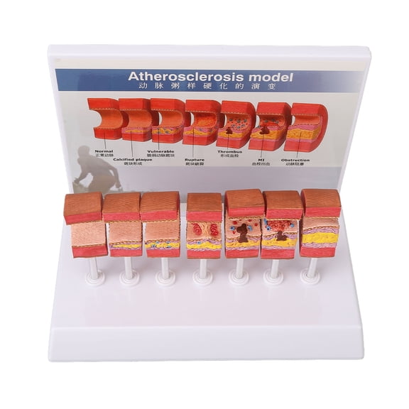 M Buder 7PCS Artery Anatomy Model Anatomical Vessel Atherosclerosis Thrombus Vascular Model for Doctors Office Educational Tool