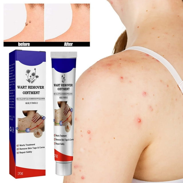 MARCUVMK “Wart Remover External Skin Use for Plantar Warts and Corns