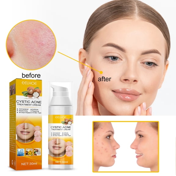 MUAXDA Acne Cream, Exfoliator with Salicylic Acid for Acne-Prone Skin, Acne defrosting, Acne Treatment Gently Exfoliates & Helps Prevent Breakouts