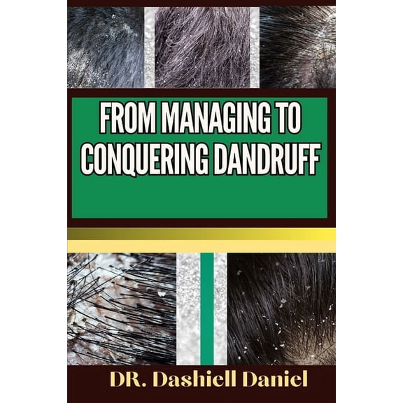 From Managing to Conquering Dandruff: Expert Guide To Understanding Causes, Identifying Symptoms, And Implementing Effective Treatments For A Scalp-Soothing Journey To Healthy Living (Paperback)