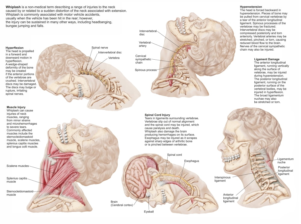 Medical chart showing the range of injuries to the human neck caused by whiplash Canvas Art - Stocktrek Images (17 x 13)