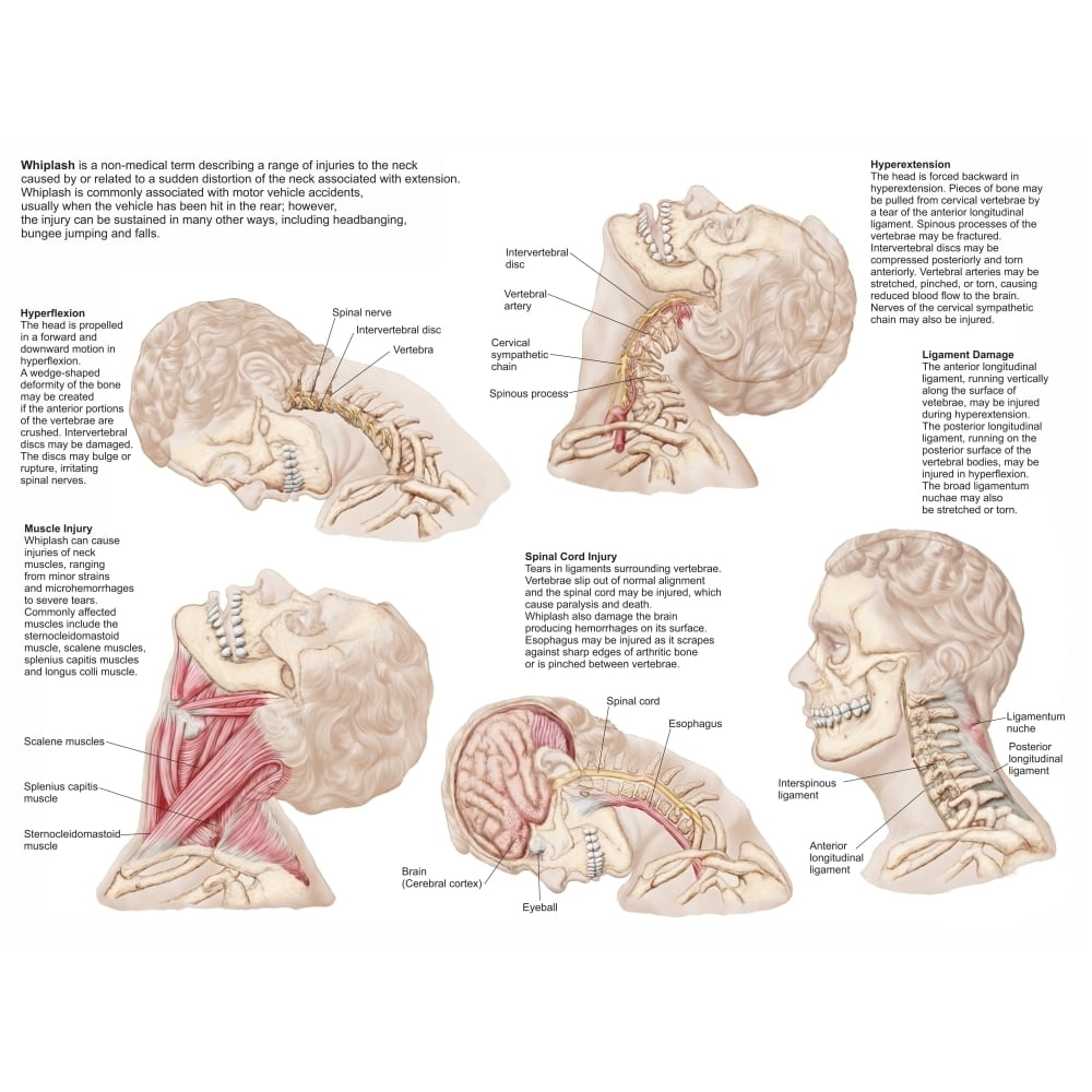 Medical chart showing the range of injuries to the human neck caused by ...