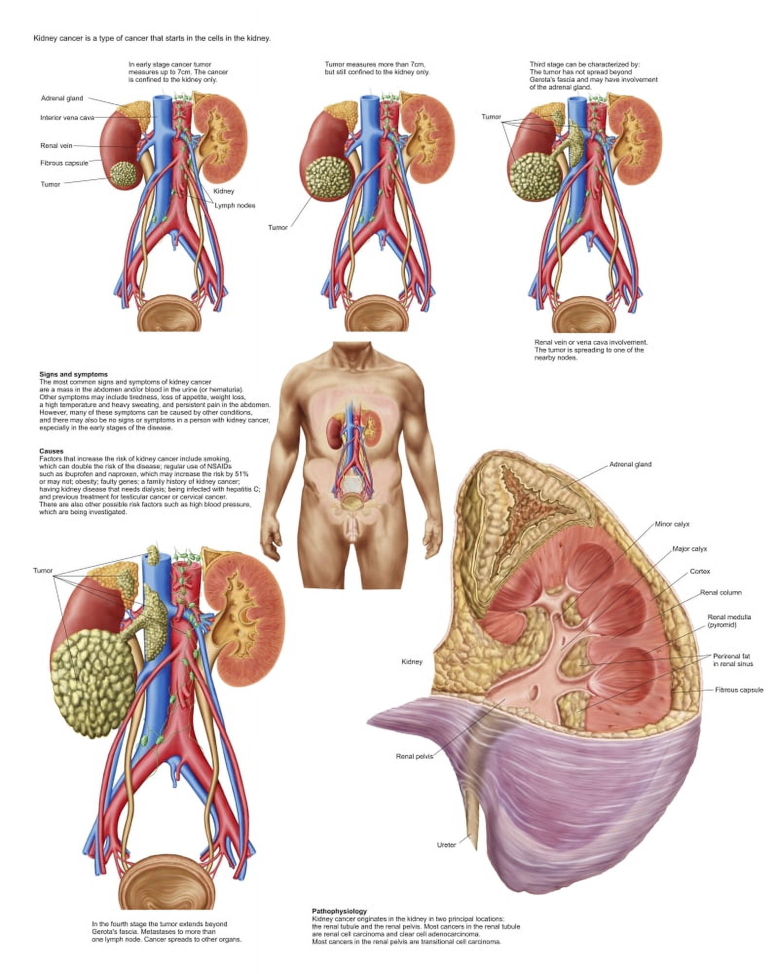 Medical chart showing the signs and symptoms of kidney cancer Canvas Art - Stocktrek Images (13 x 16)