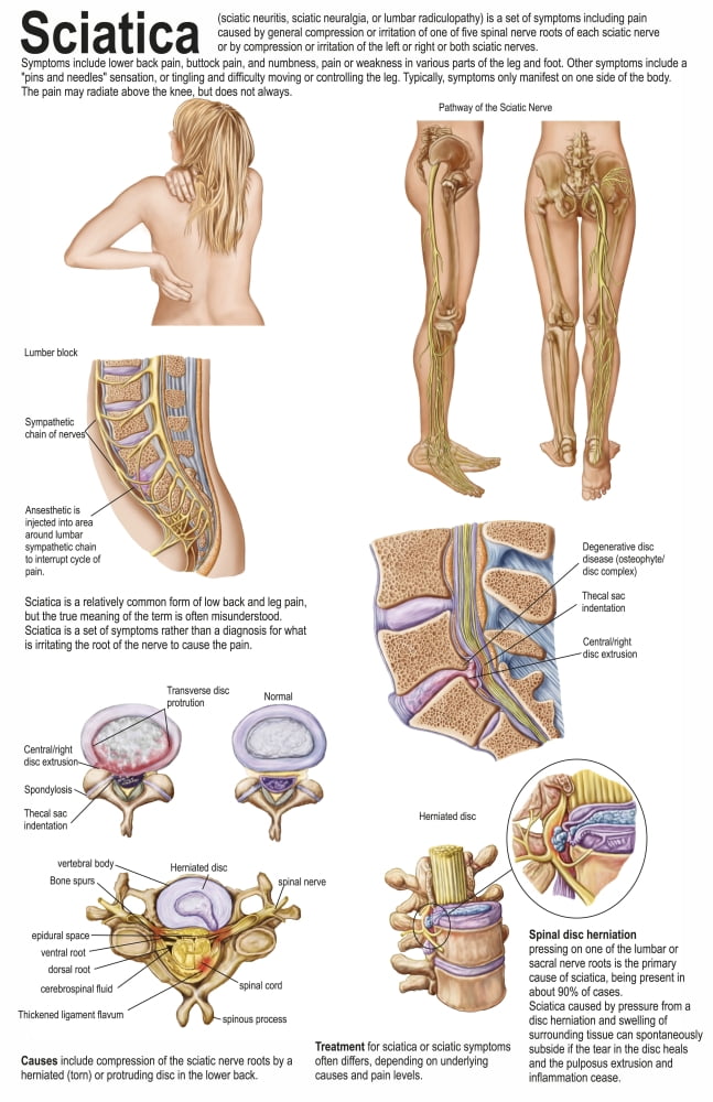 Medical chart showing the signs and symptoms of sciatica Canvas Art - Stocktrek Images (23 x 35)