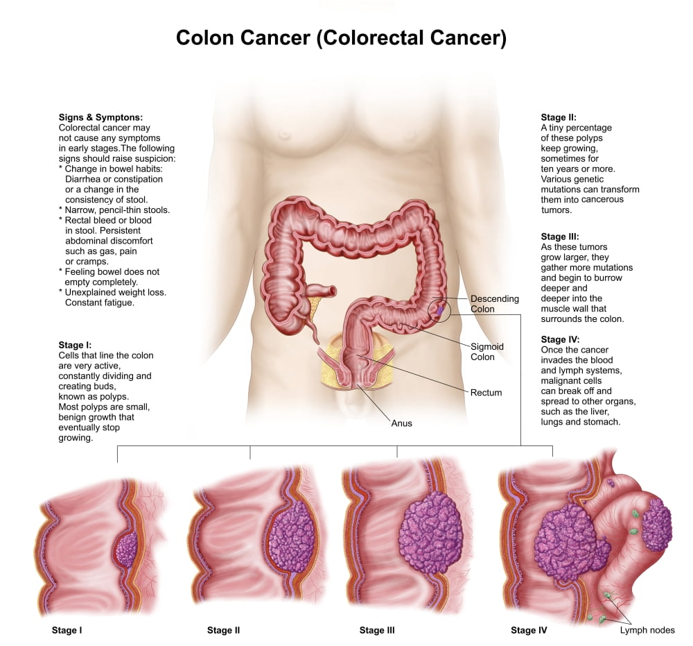 Medical illustration depicting the different stages of colon cancer Canvas Art - Stocktrek Images (29 x 27)