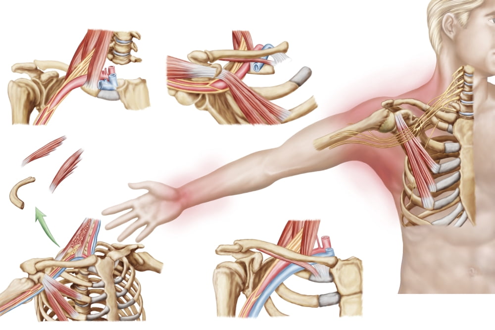 Medical illustration detailing thoracic outlet syndrome Canvas Art - Stocktrek Images (18 x 12)