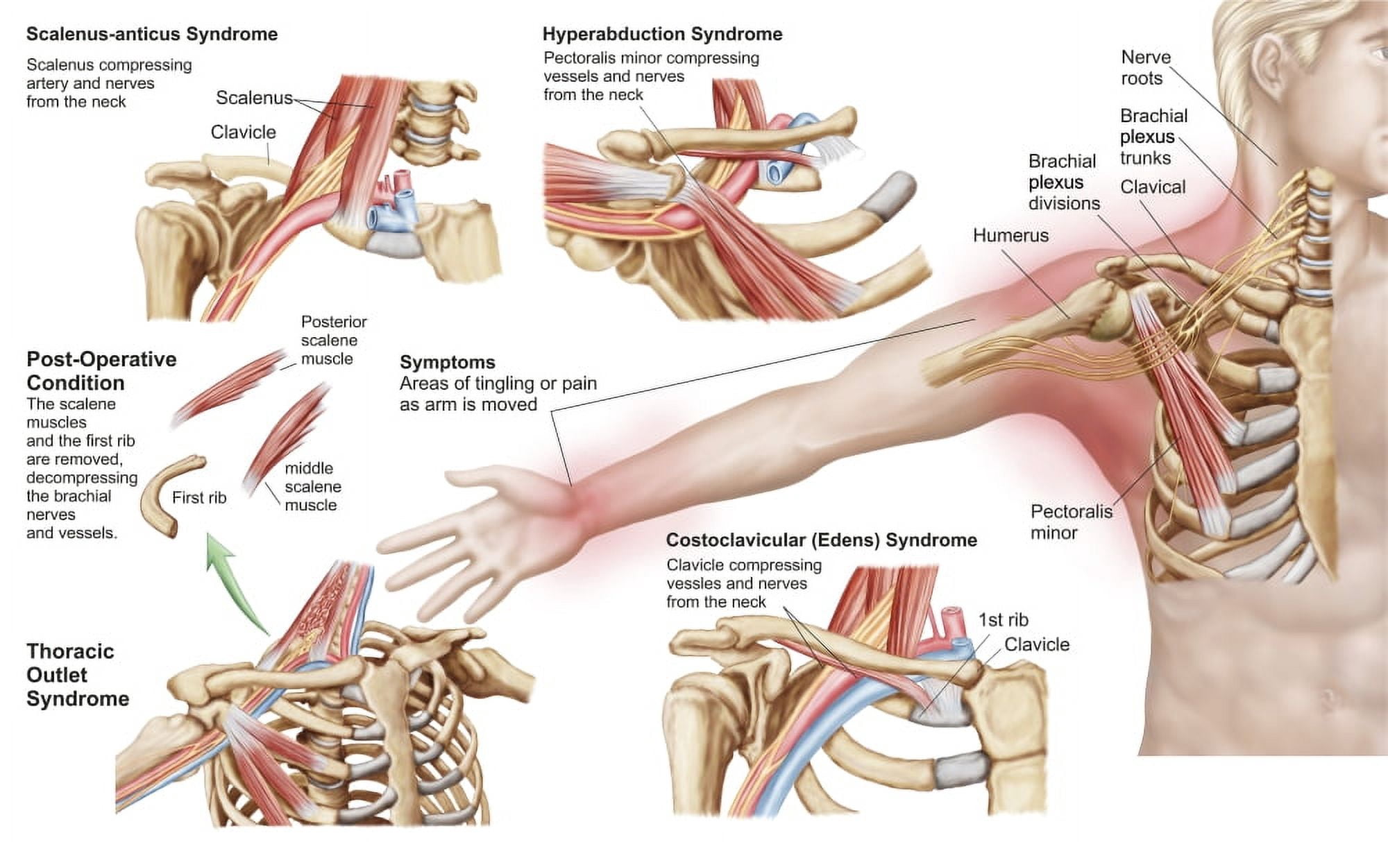 Medical illustration detailing thoracic outlet syndrome Canvas Art - Stocktrek Images (37 x 22)