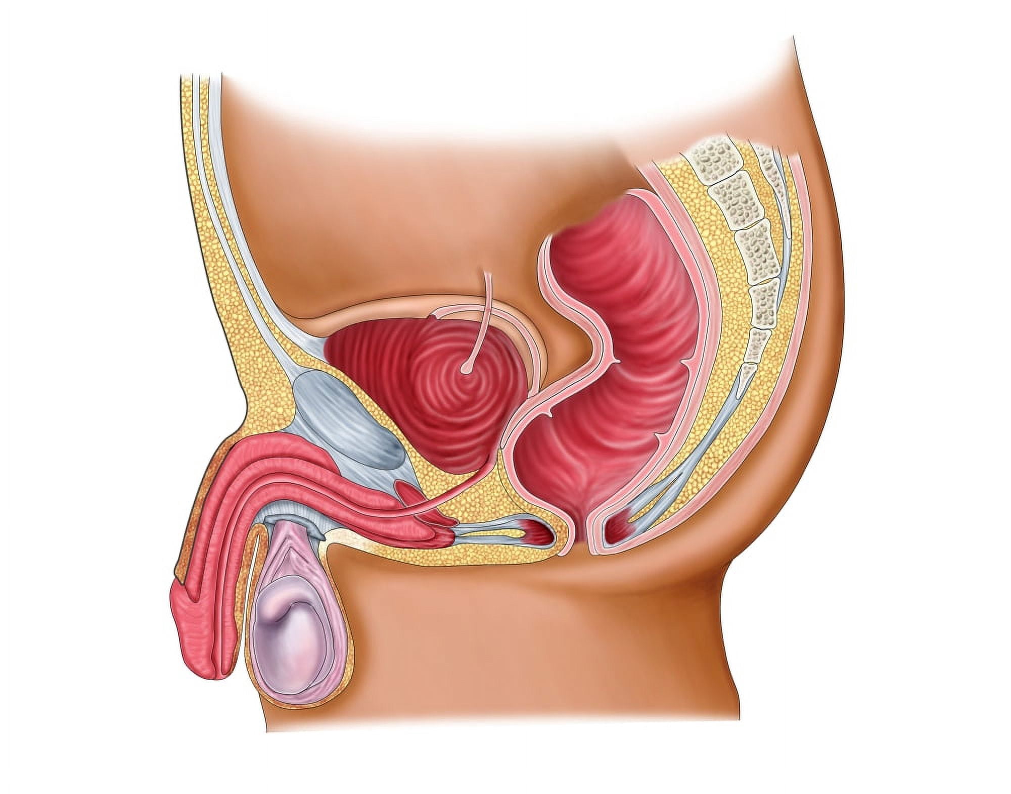 Medical illustration of a rectourethral fistula Canvas Art - Stocktrek Images (32 x 26)