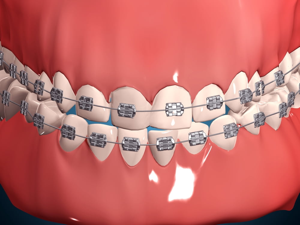 Medical illustration of human mouth showing teeth gums and metal braces Canvas Art - Stocktrek Images (17 x 13)