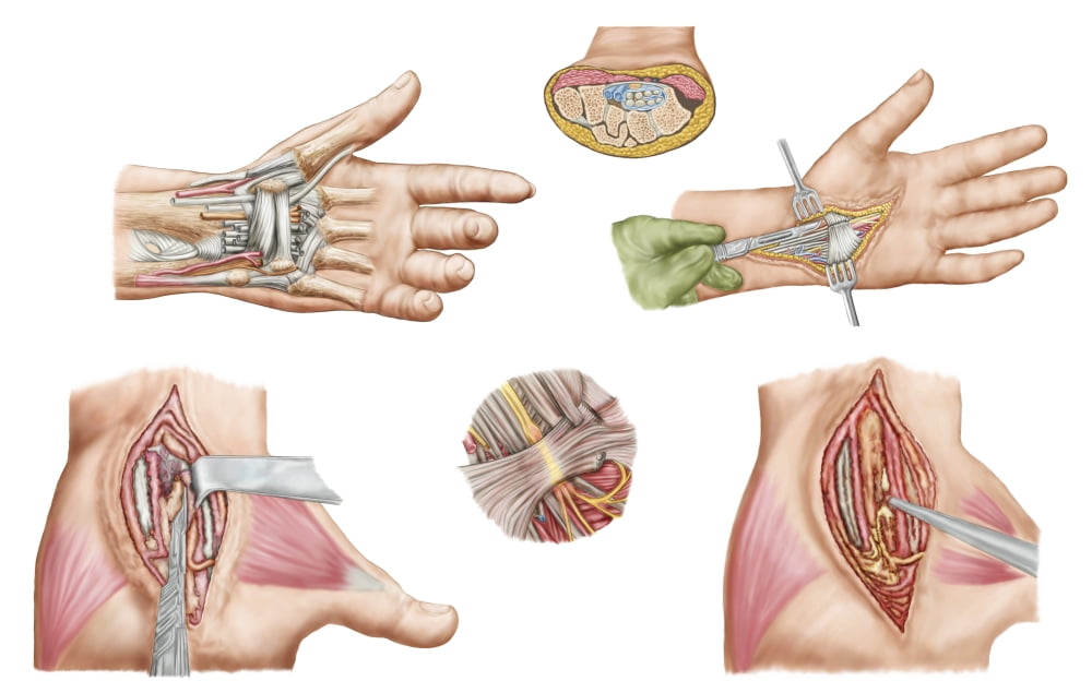Medical illustration showing carpal tunnel syndrome in the human wrist Canvas Art - Stocktrek Images (18 x 12)