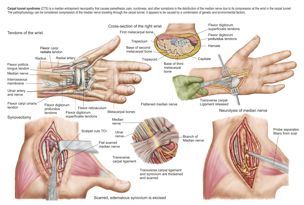 Medical illustration showing carpal tunnel syndrome in the human wrist Canvas Art - Stocktrek Images (35 x 24)