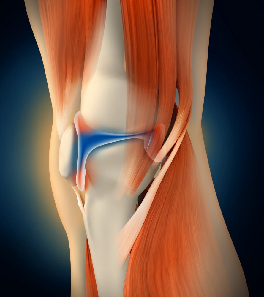 Medical illustration showing inflammation in human knee joint Canvas Art - Stocktrek Images (27 x 30)