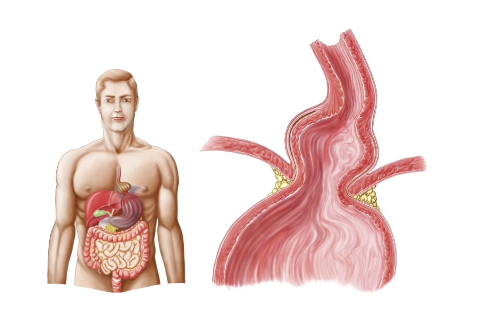 Medical ilustration of a hiatal hernia in the upper part of the stomach into the thorax Canvas Art - Stocktrek Images (36 x 23)