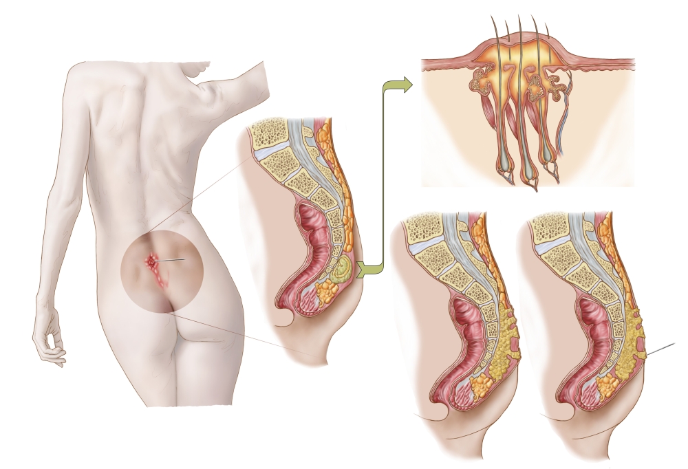 Medical ilustration of a pilonidal cyst near the natal cleft of the buttocks Canvas Art - Stocktrek Images (18 x 12)