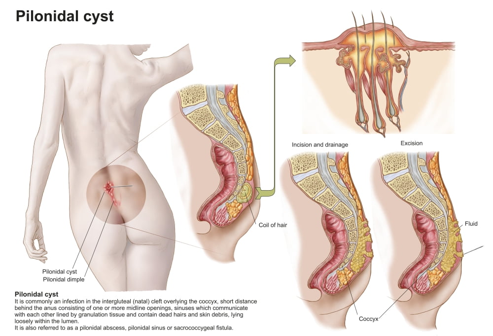 Medical ilustration of a pilonidal cyst near the natal cleft of the buttocks Canvas Art - Stocktrek Images (35 x 24)