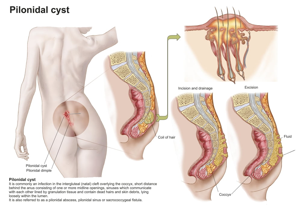 Pilonidal Cyst - DR. NOVIKOV WELLNESS AND SKIN CARE